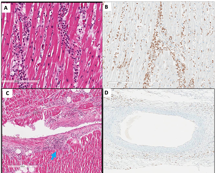 inflammation in heart vessels